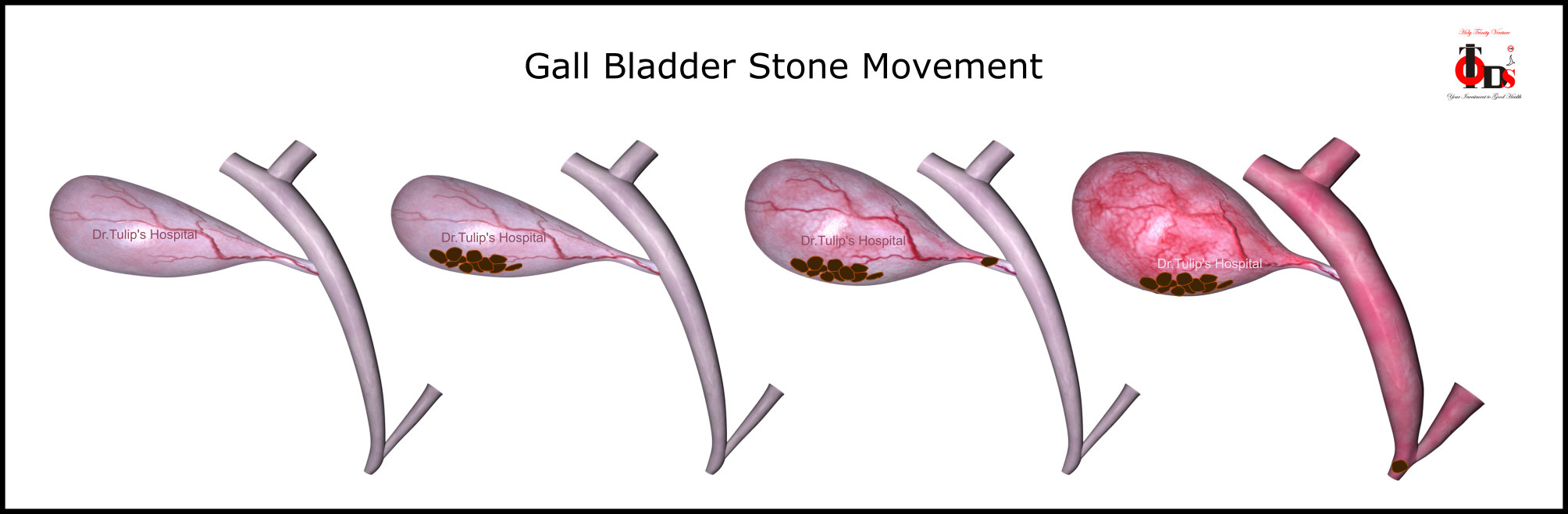 Gall bladder 